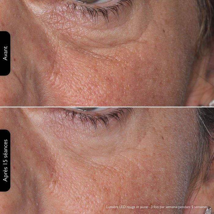 Silk'n Lumino - Mask Led Luminotherapie 100leds - Automatic routine programs - anti aging / anti imperfection sessions
