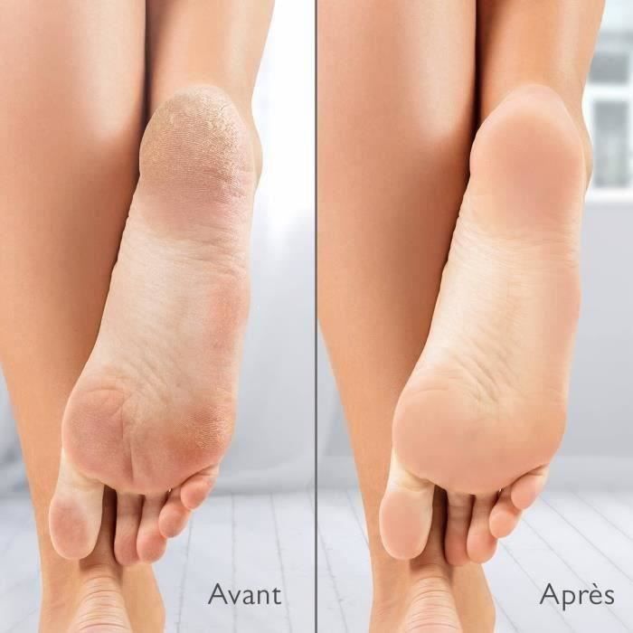 Silk'n Vacupedi Electric Callus Remover with Built-in Suction and 2 Files Included